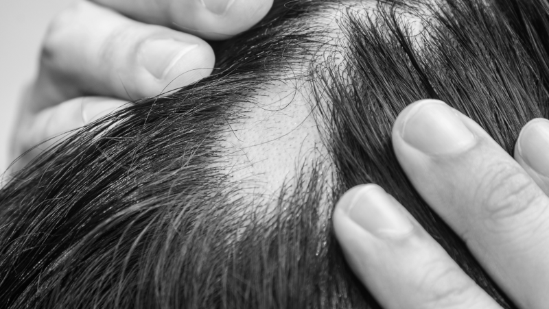 Les Différences Entre l'Alopécie Masculine et Féminine : Comprendre la Perte de Cheveux