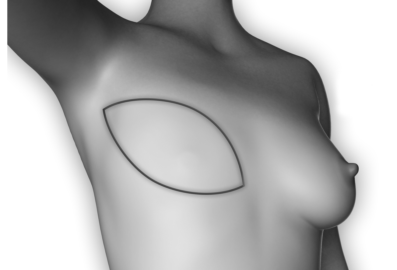 Chirurgie esthétique reconstruction mammaire