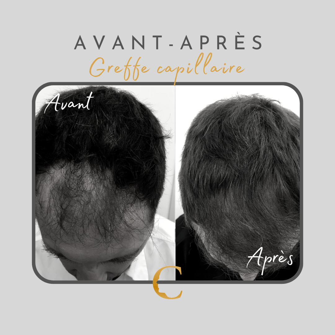 Alopécie homme Lyon 