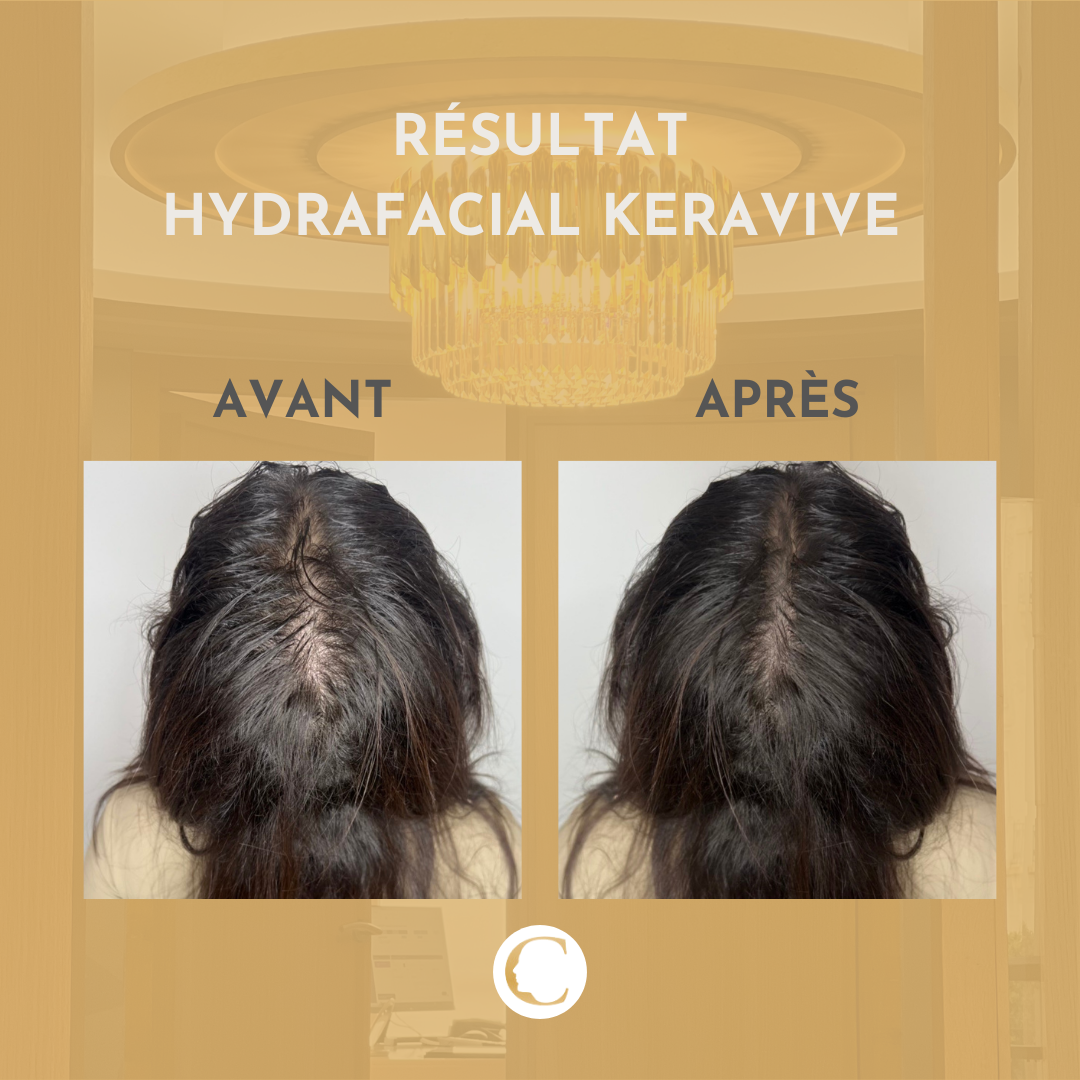 Traitements capillaire Lyon 