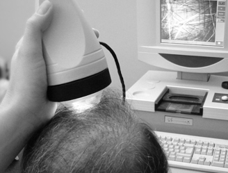 Bilan capillaire lyon 6 clinique crillon cheveu