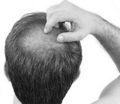 microgreffe de cheveux clinique crillon lyon FUE FUT