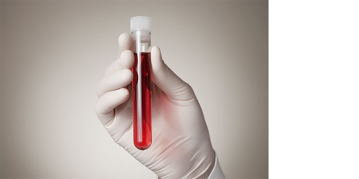 injection PRP I-PRF LYON CLINIQUE CRILLON