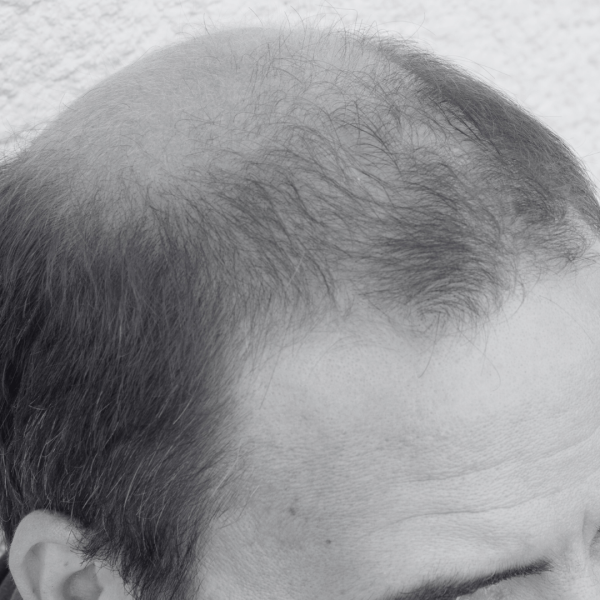 Tricopigmentation cheveux 