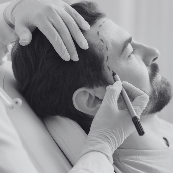 La greffe capillaire contre l'alopécie 